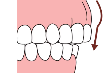 Overlapping Teeth