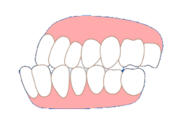 Underbite